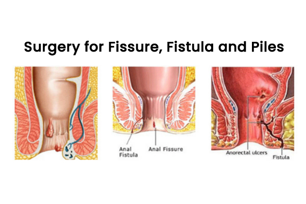 Surgery for Fissure, Fistula and Piles