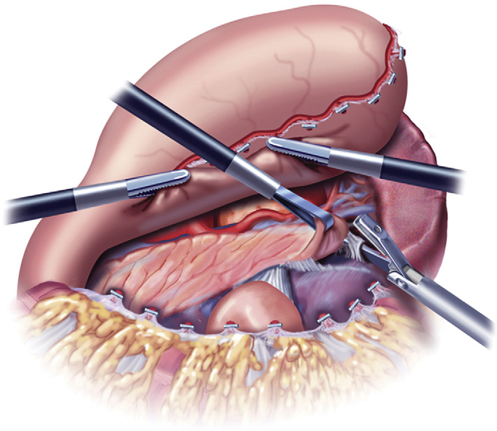 Laparoscopic Distal Pancreatectomy