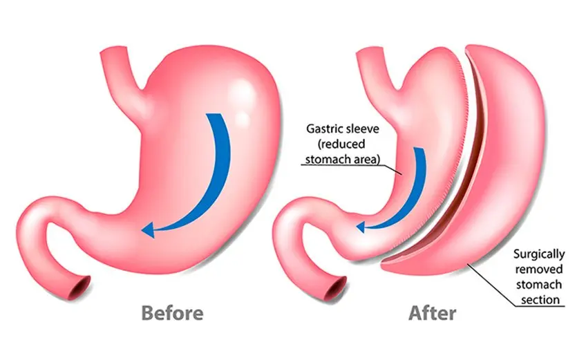 Laparoscopic Gastrectomy